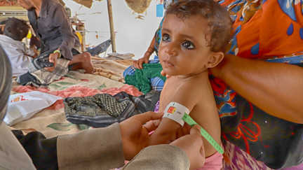 Undernärt barn får behandling i Jemen 