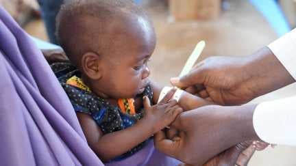 Fawzia, 9 månader, får behandling mot undernäring på en av Rädda Barnens hälsokliniker i Somalia.